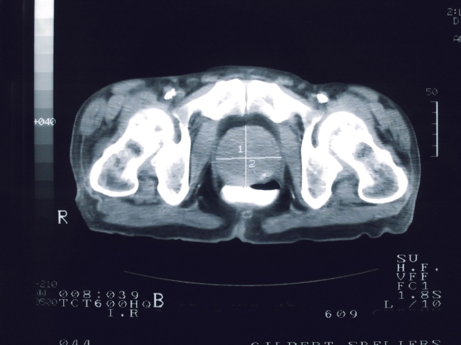 prostate scan