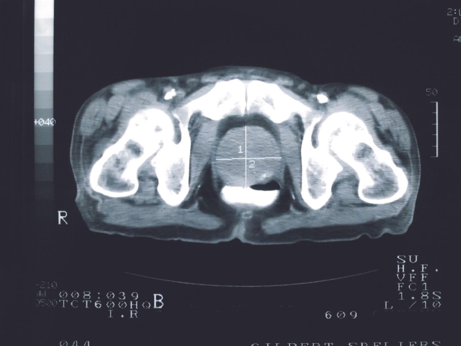 Reducing Radiation Exposure With Proton Therapy for Prostate Cancer