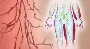 Preventing Lymphedema: What Patients Need to Know