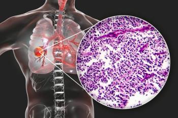 Image of small cell lung cancer.