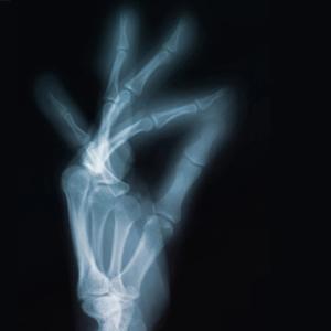 No Increase in Skeletal-Related Events With Less Frequent Use of Zoledronic Acid