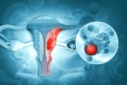 Keytruda Regimen Misses Goal in Endometrial Cancer Trial