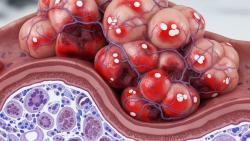 Bezuclastinib and Sutent Combo Shows Improved Outcomes in GIST 