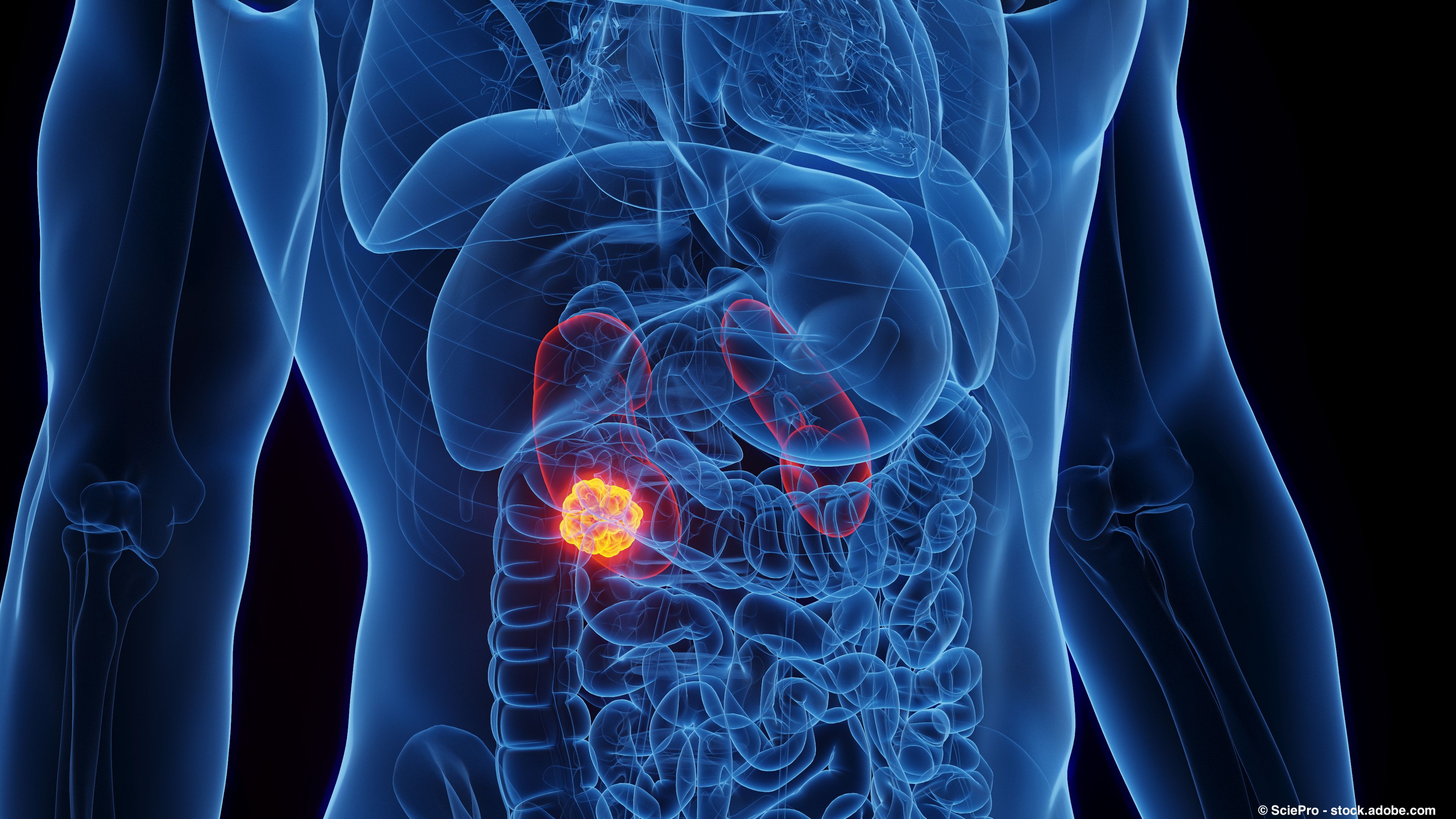 Results were consistent with research in advanced renal cell carcinoma treated with Cabometyx, Opdivo and Yervoy: © SciePro - stock.adobe.com.