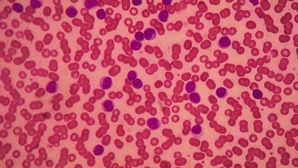 Image of Leukemia