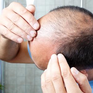 Patients' Gray Hair Turns Dark After Immunotherapy for Lung Cancer