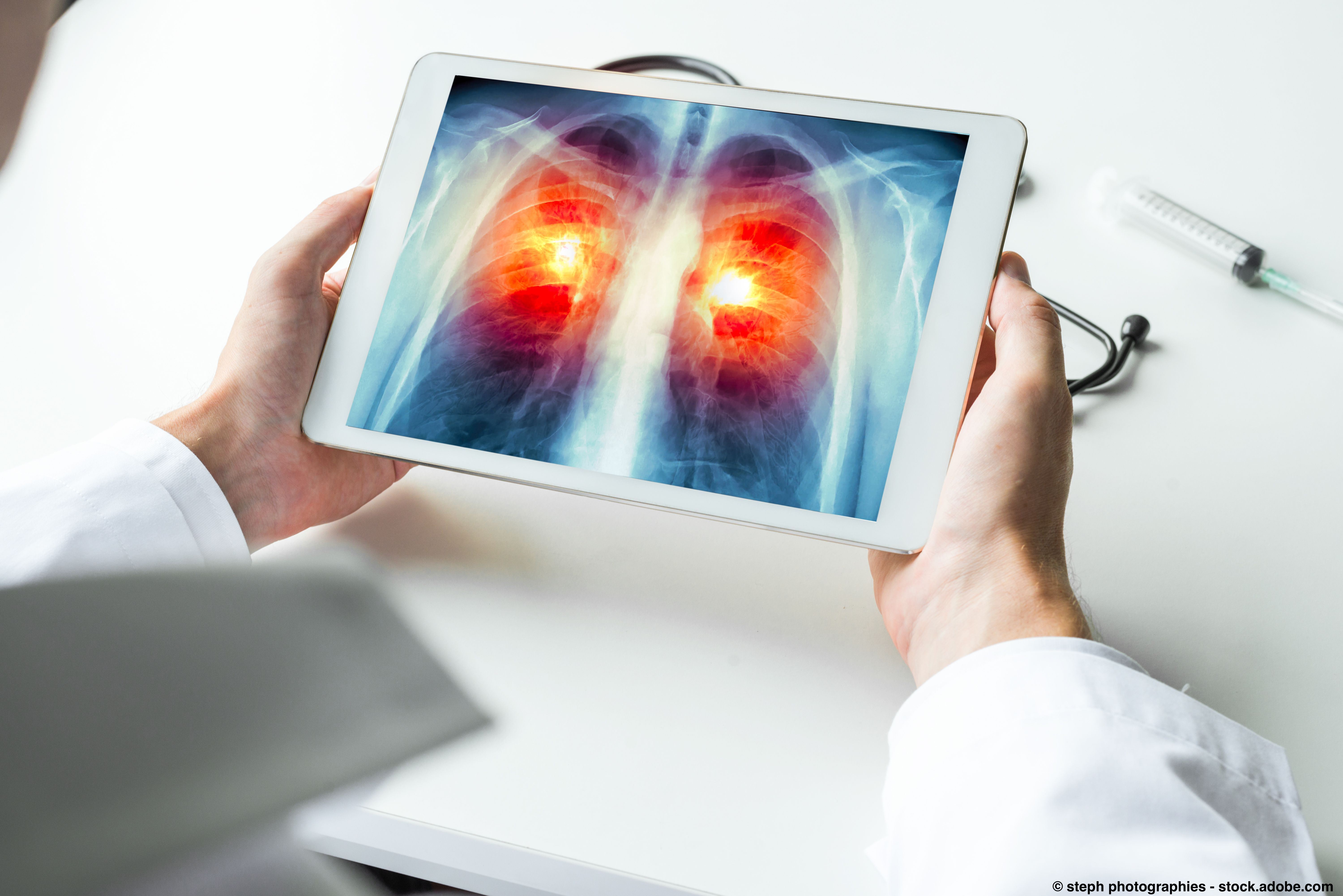 THIO sequenced with Libtayo extended OS in NSCLC following progression. | © steph photographies - stock.adobe.com