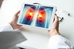 THIO and Libtayo Extends OS in NSCLC Following Progression on SOC Therapy