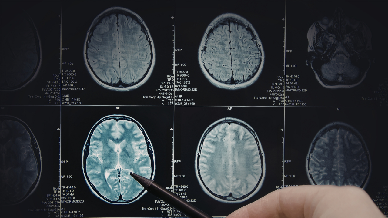 Adjuvant Temozolomide Improves Survival in 1p / 19q Non - Co - Deleted Glioma