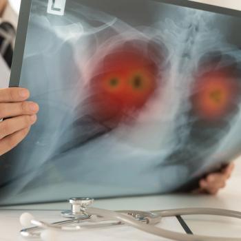 The first patient has been dosed with mavrostobart plus chemo in the phase 1/2 MORNINGSTAR trial: © stock.adobe.com.
