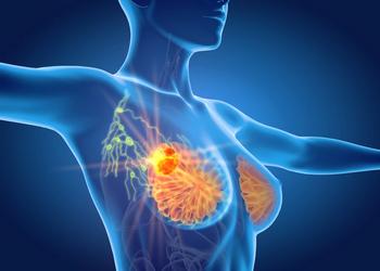 Illustration of breasts with a tumor in the right breast.
