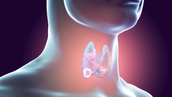 throat cancer