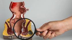 Anal Cancer Basics: An Overview from Diagnosis to Survivorship