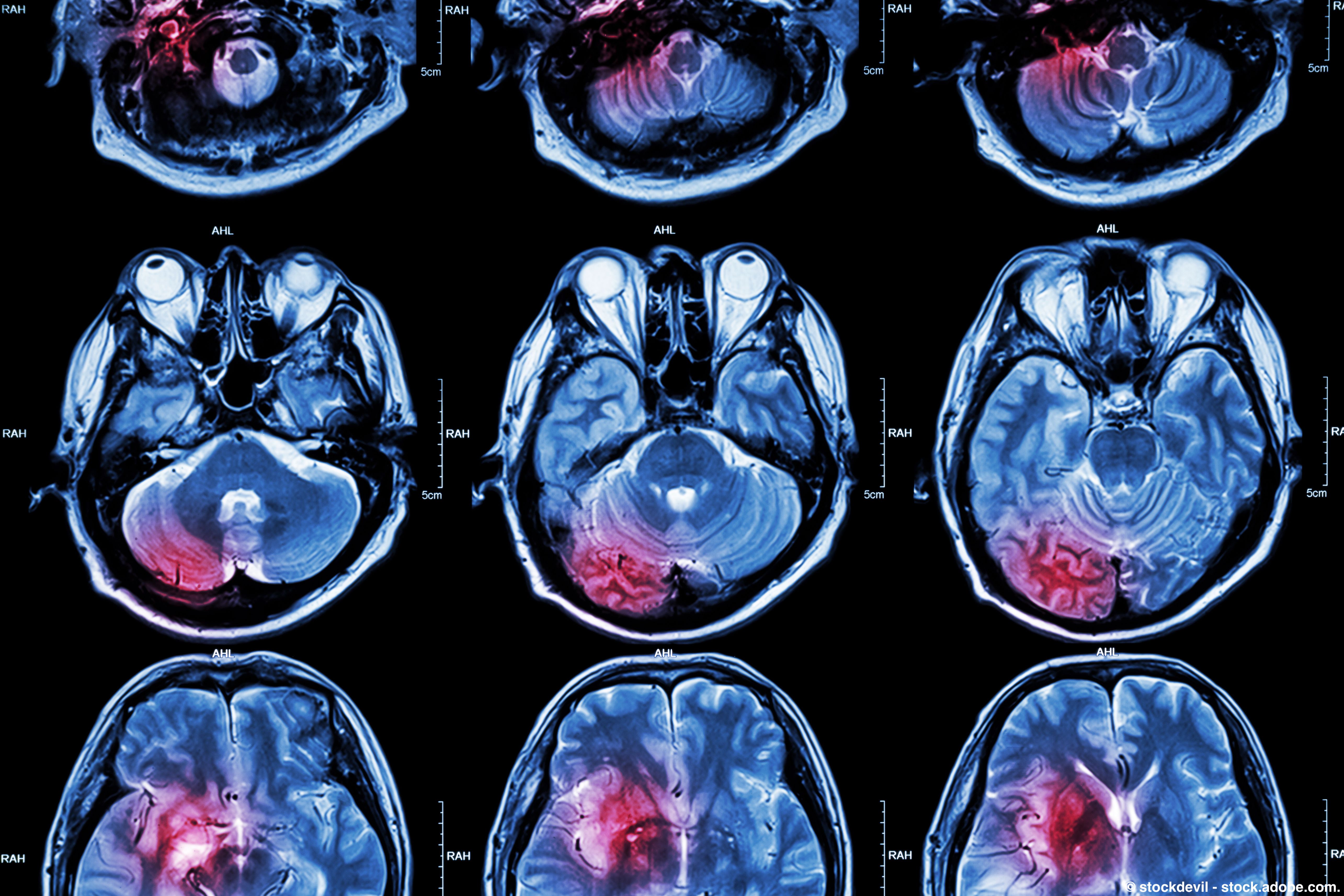 Concomitant radiotherapy and temozolomide increases PFS in IDH-wildtype glioblastoma. | © stockdevil - stock.adobe.com