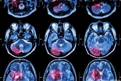 Radiotherapy and Temozolomide Improve PFS in IDH-Wildtype Glioblastoma 