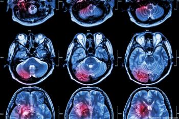 Concomitant radiotherapy and temozolomide increases PFS in IDH-wildtype glioblastoma. | © stockdevil - stock.adobe.com