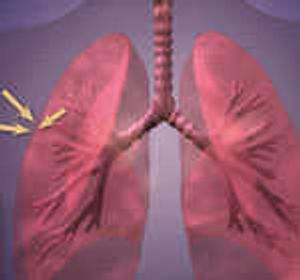 FDA Approves Cyramza for Lung Cancer