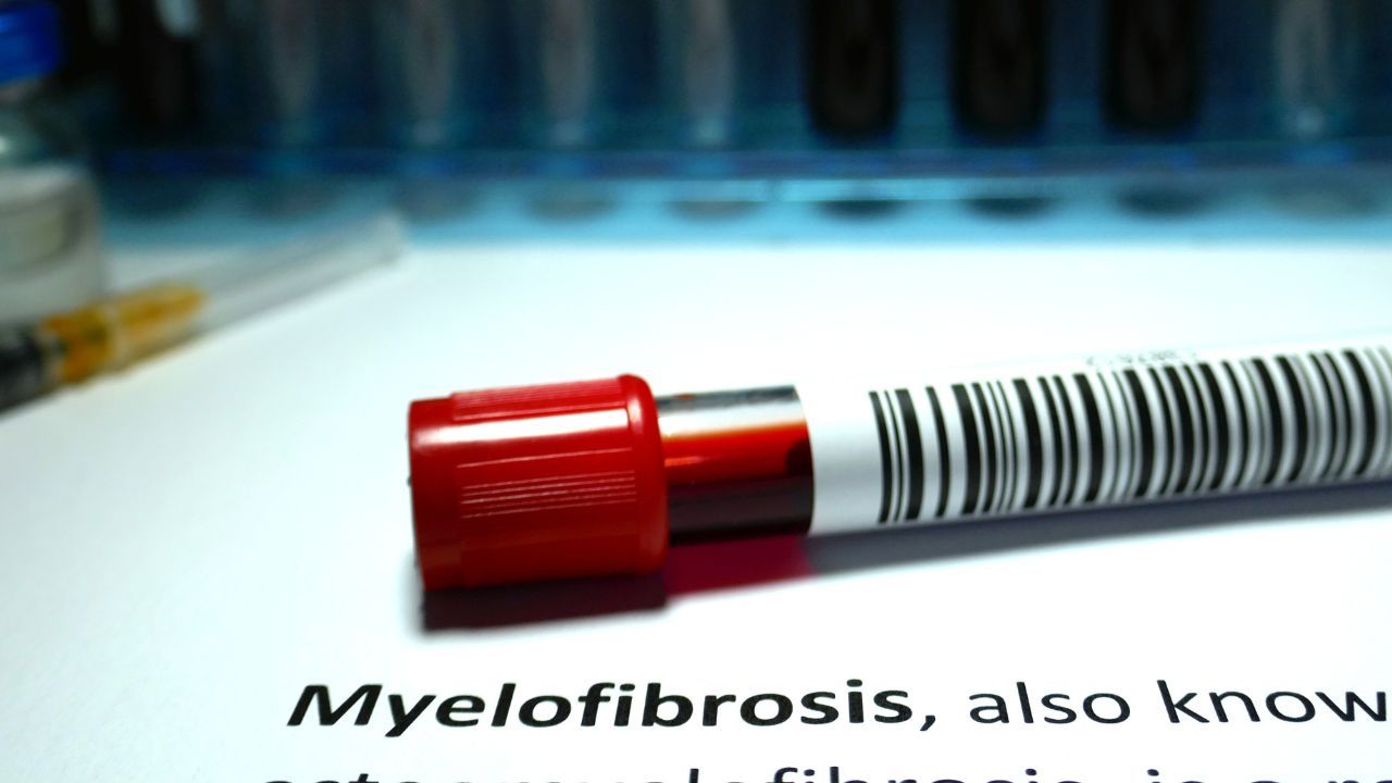<![CDATA[An Educational Overview of Newly Diagnosed Stage 1 Myelofibrosis]]>
