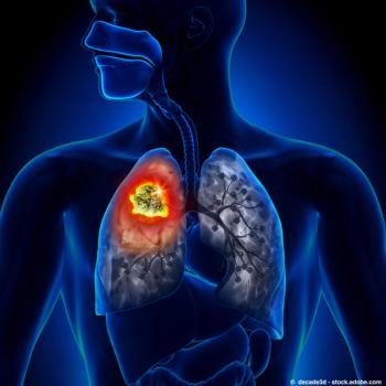 An image of lung cancer.