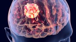 Voranigo Continues to Benefit Patients With Grade 2 IDH-Mutated Glioma