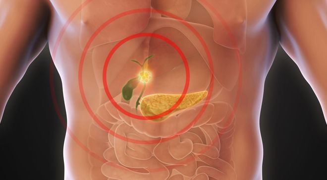 Image of cholangiocarcinoma.