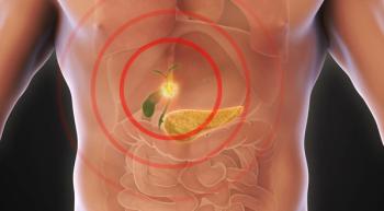 Image of cholangiocarcinoma.
