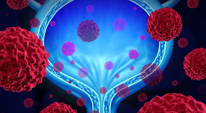 Illustration of tumors invading the bladder.