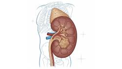 Understanding Stage 2 Kidney Cancer (Renal Cell Carcinoma)