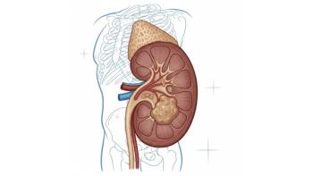 Image representing renal cell carcinoma