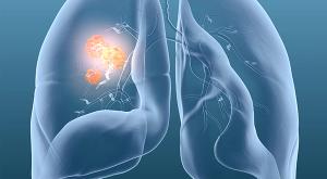 lung cancer image