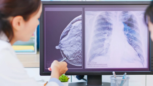 Giredestrant Combo Cuts Progression Risk by 44% in Advanced Breast Cancer
