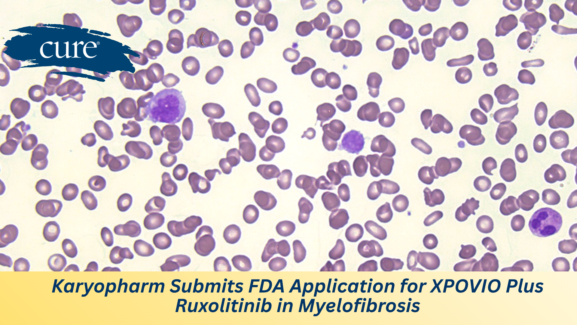 Image of Myelofibrosis