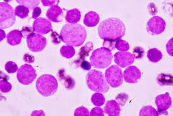 Image of acute myeloid leukemia. 
