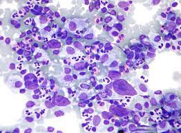 Image of lymphoma