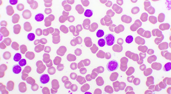AML cells
