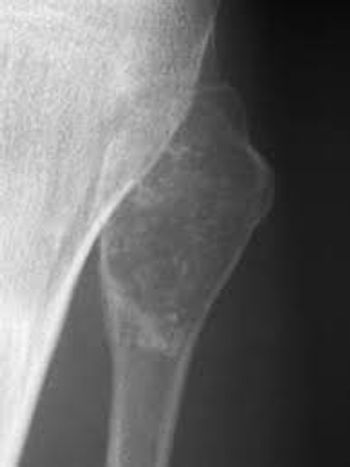 image of a patient with chondrosarcomas