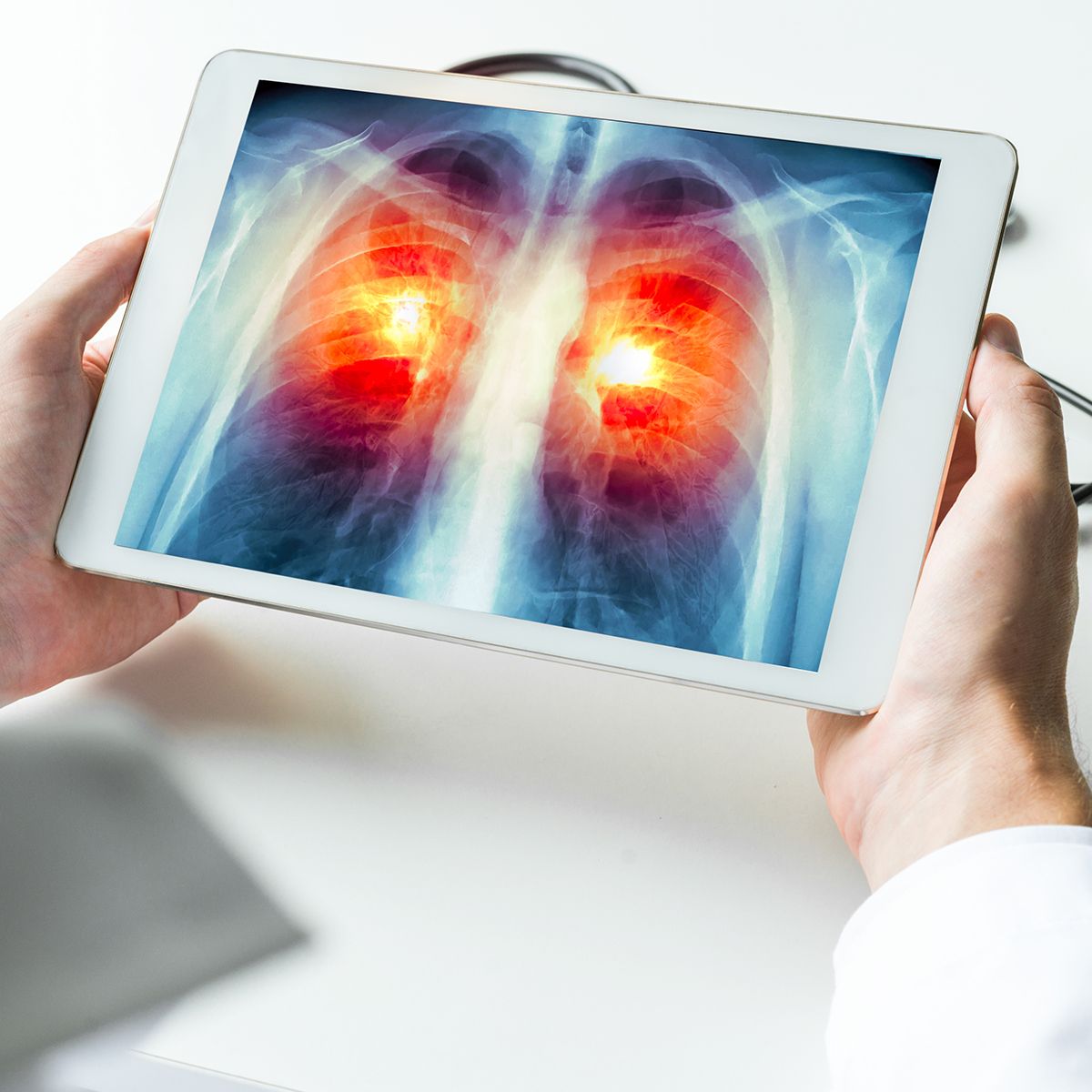 CAN-2409 elicited responses among patients with pretreated stage 3/4 non–small cell lung cancer: © steph_photographis - stock.adobe.com