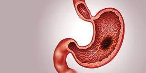 stomach CANCER