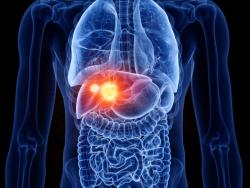 A Phase 3 Trial of Amezalpat in Advanced Liver Cancer Receives Study May Proceed Letter 