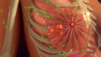 Image of metastatic breast cancer.
