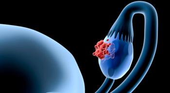 ovary with tumor on it
