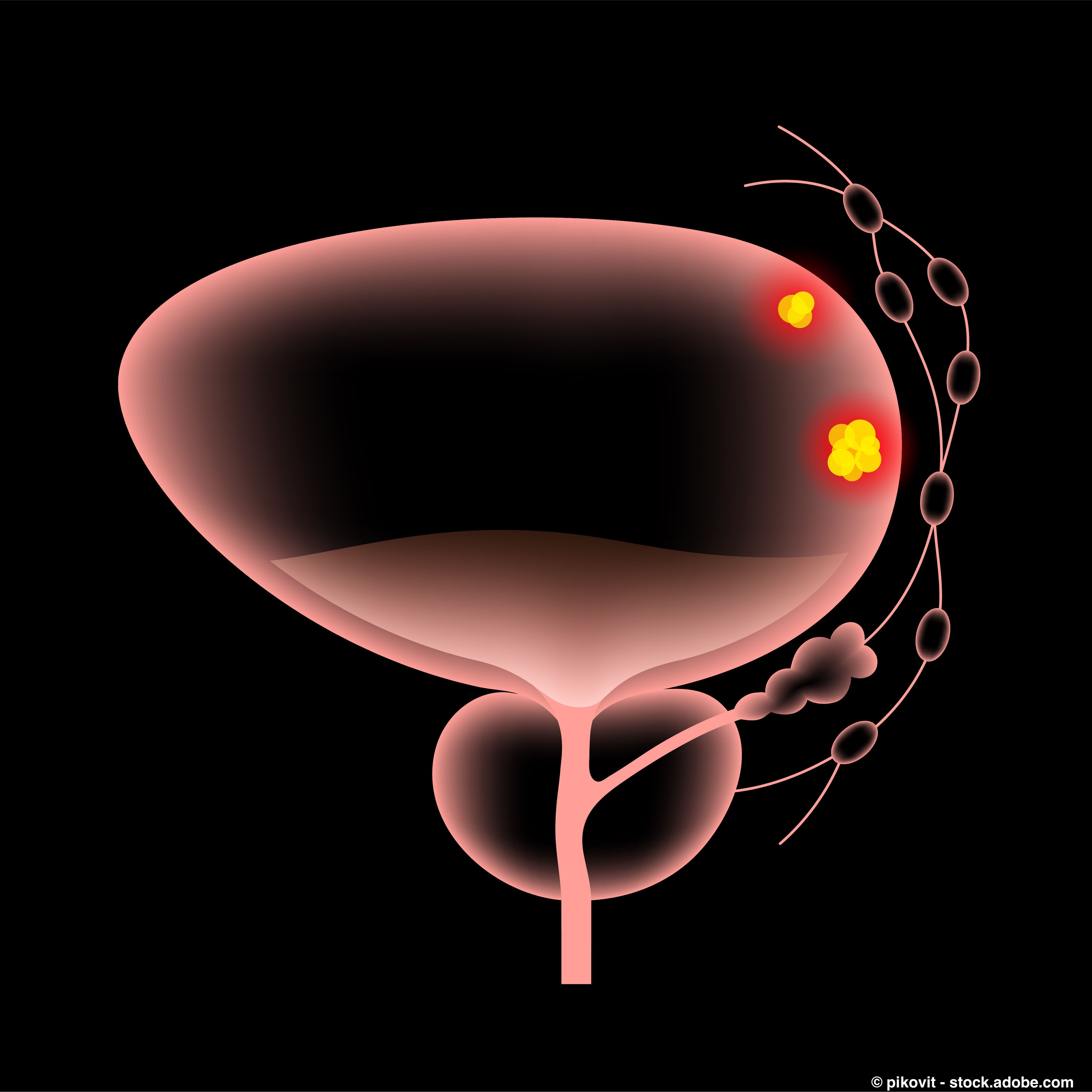 Although carbon ion radiation led to a decline in urinary function among patients with prostate cancer, function returned to normal after three months. | © pikovit - stock.adobe.com