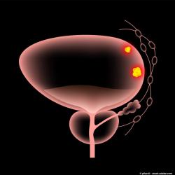 Patients With Prostate Cancer Experience Temporary Urinary Function Decline After CIRT