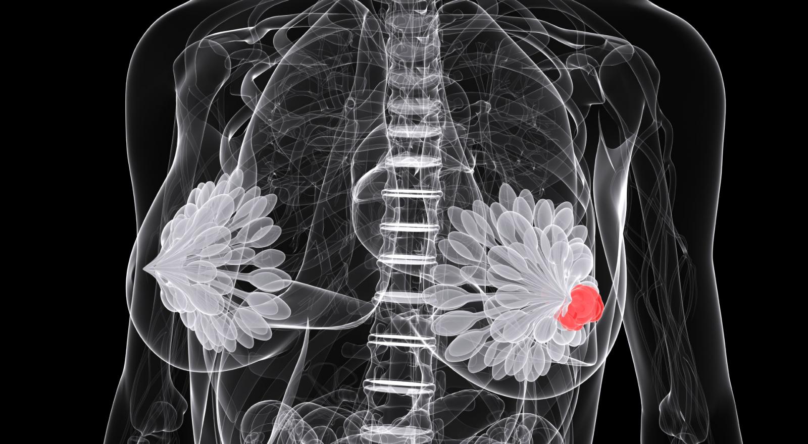 Illustration of a person with a tumor in their left breast.