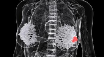 Illustration of a person with a tumor in their left breast.