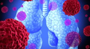 Tagrisso Following Surgery Improves Survival in Patients with EGFR-Mutated Advanced Non-Small Cell Lung Cancer