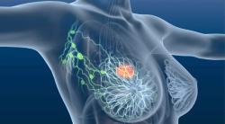 First Patient Dosed in Trial of INT230-6 For Triple-Negative Breast Cancer