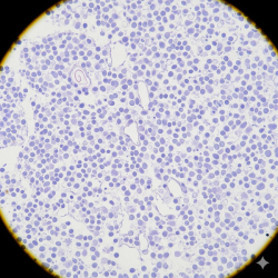 Lunsumio plus Polivy Associated With Responses in MCL