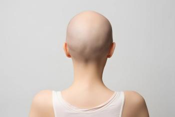 Back of head of bald woman with medical condition causing hair loss like Alopecia or chemotherapy | Image credit: © - Firn - © stock.adobe.com