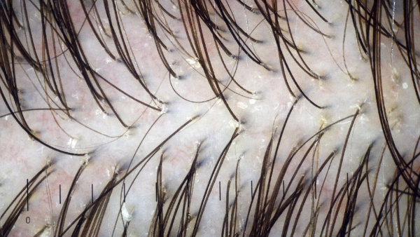 Image of Scalp 
